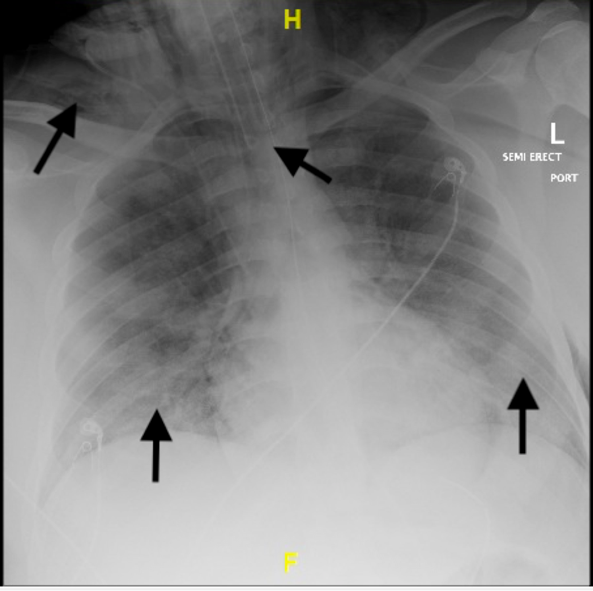 Cureus | ST-Elevation Myocardial Infarction in a 27-Year-Old Male With ...