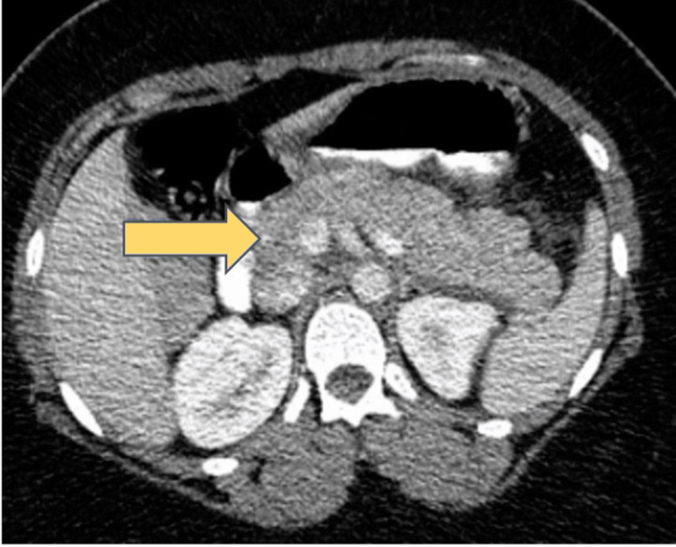 injecting semaglutide Where to Inject Semaglutide: Abdomen, Thigh, or Arm?