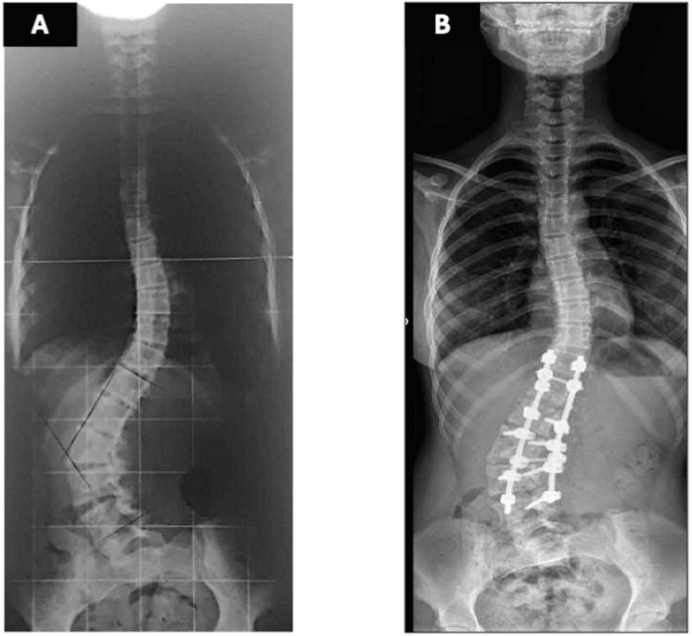 Anteroposterior-spinal-radiographs. Anteroposterior-spinal-radiographs.