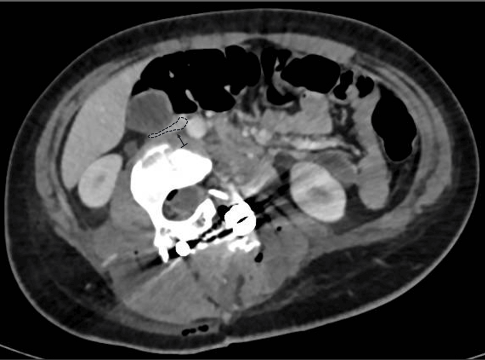 CT-angiography; extrinsic-compression-of-the-inferior-vena-cava. CT-angiography; extrinsic-compression-of-the-inferior-vena-cava.
