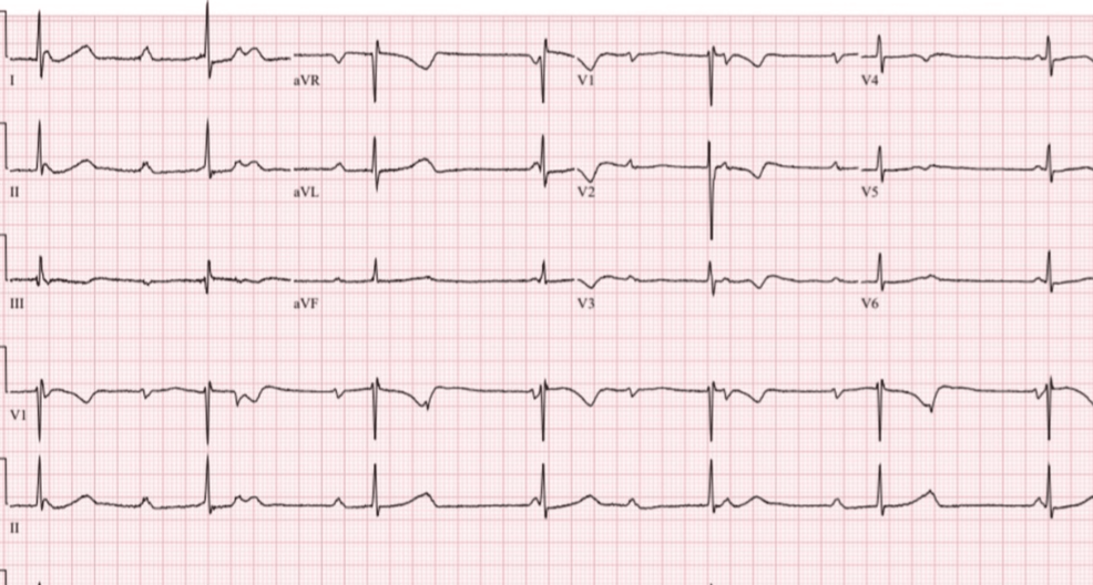 ECG-of-the-patient-showing-sinus-rhythm-with-complete-dissociation-of-P-waves-from-QRS-complexes,-indicating-complete-heart-block-with-junctional-bradyarrhythmia.