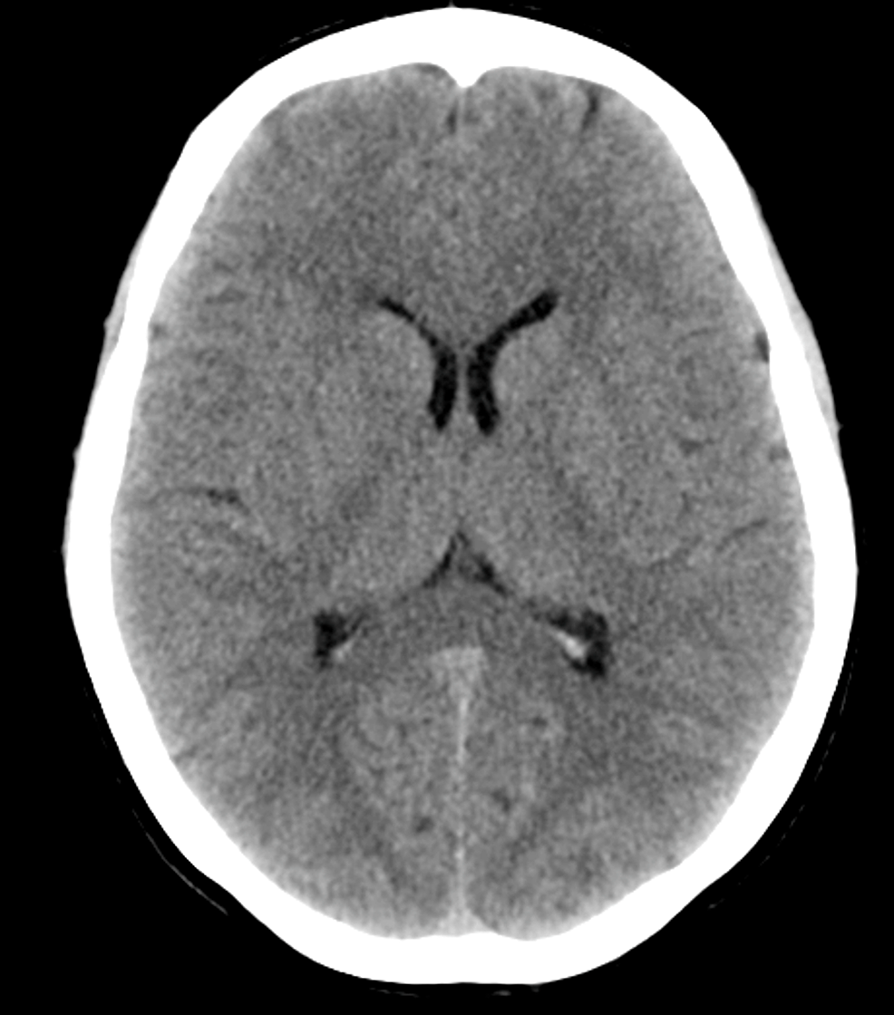 CT-scan-of-the-brain