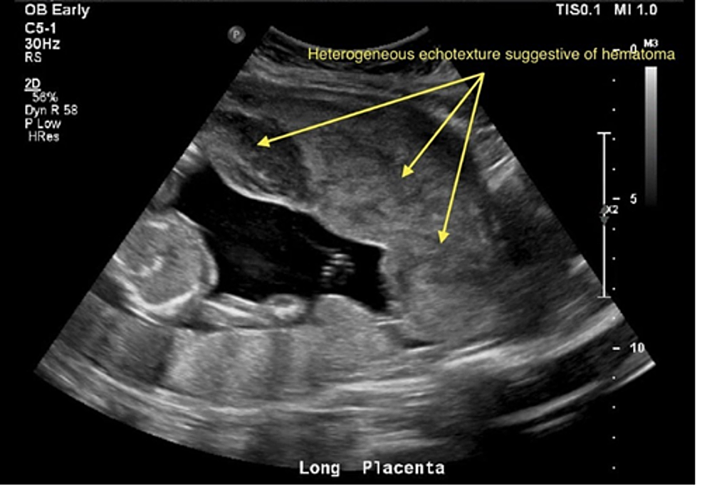 retained-placenta