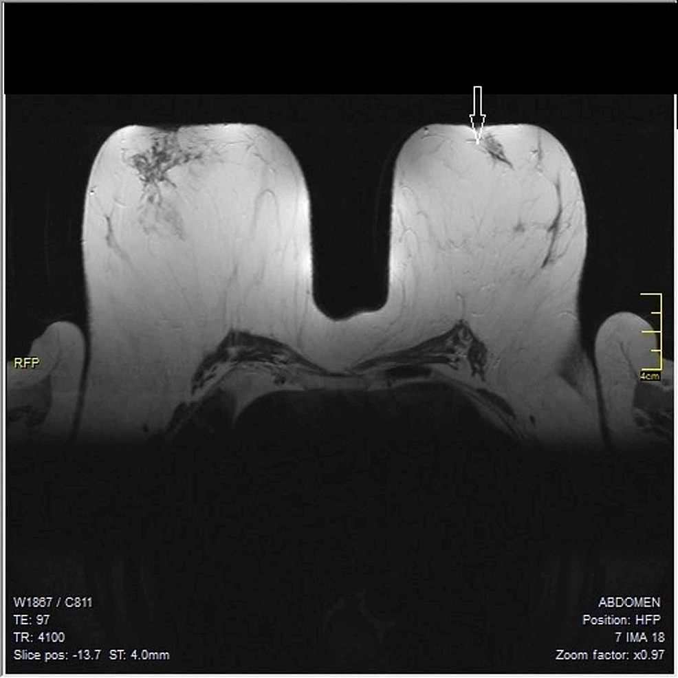 Mrm Surgery Full Form