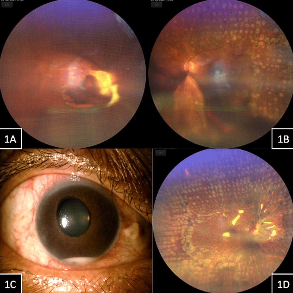 Effective Non-Surgical Approaches to Treating Inflammatory Anterior Chamber Hypopyon After Vitreoretinal Surgery for Proliferative Diabetic Retinopathy