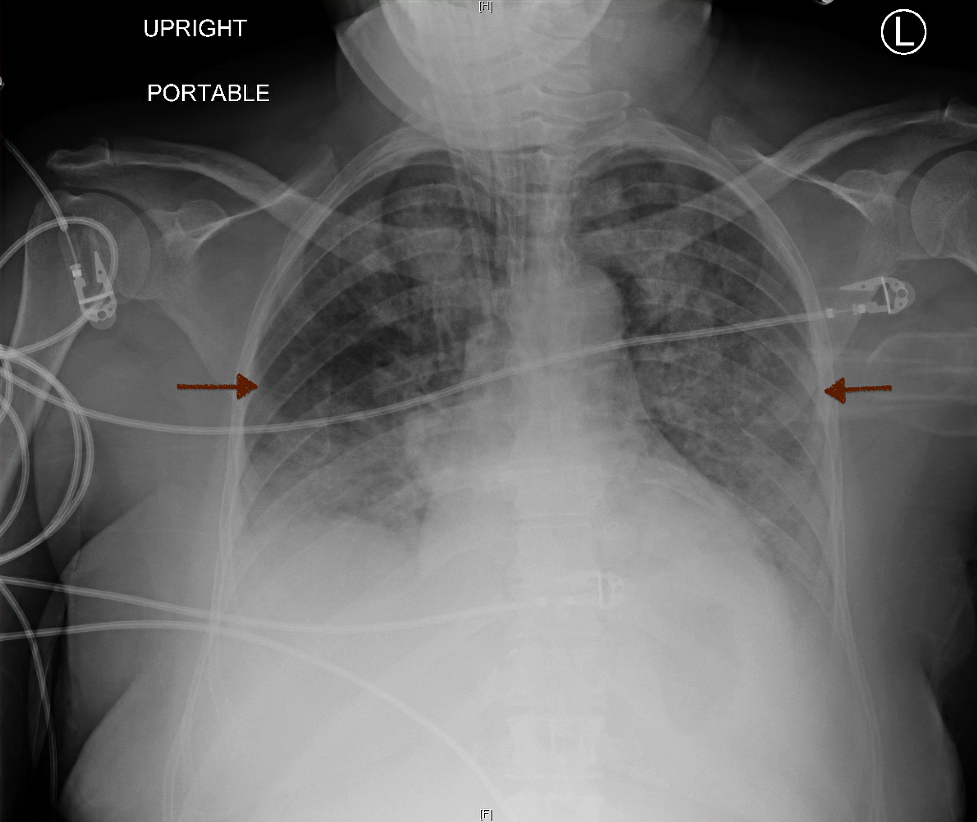 Cureus | The Awareness Of Negative Pressure Pulmonary Edema In The ...