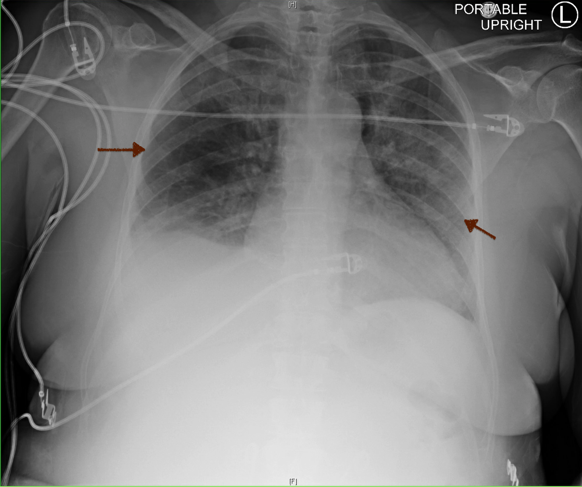 Cureus The Awareness Of Negative Pressure Pulmonary Edema In The Medical Intensive Care Unit 7490