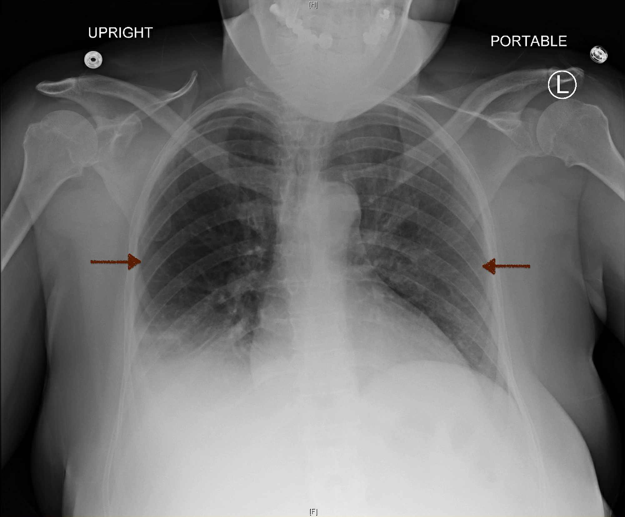 Cureus | The Awareness Of Negative Pressure Pulmonary Edema In The ...