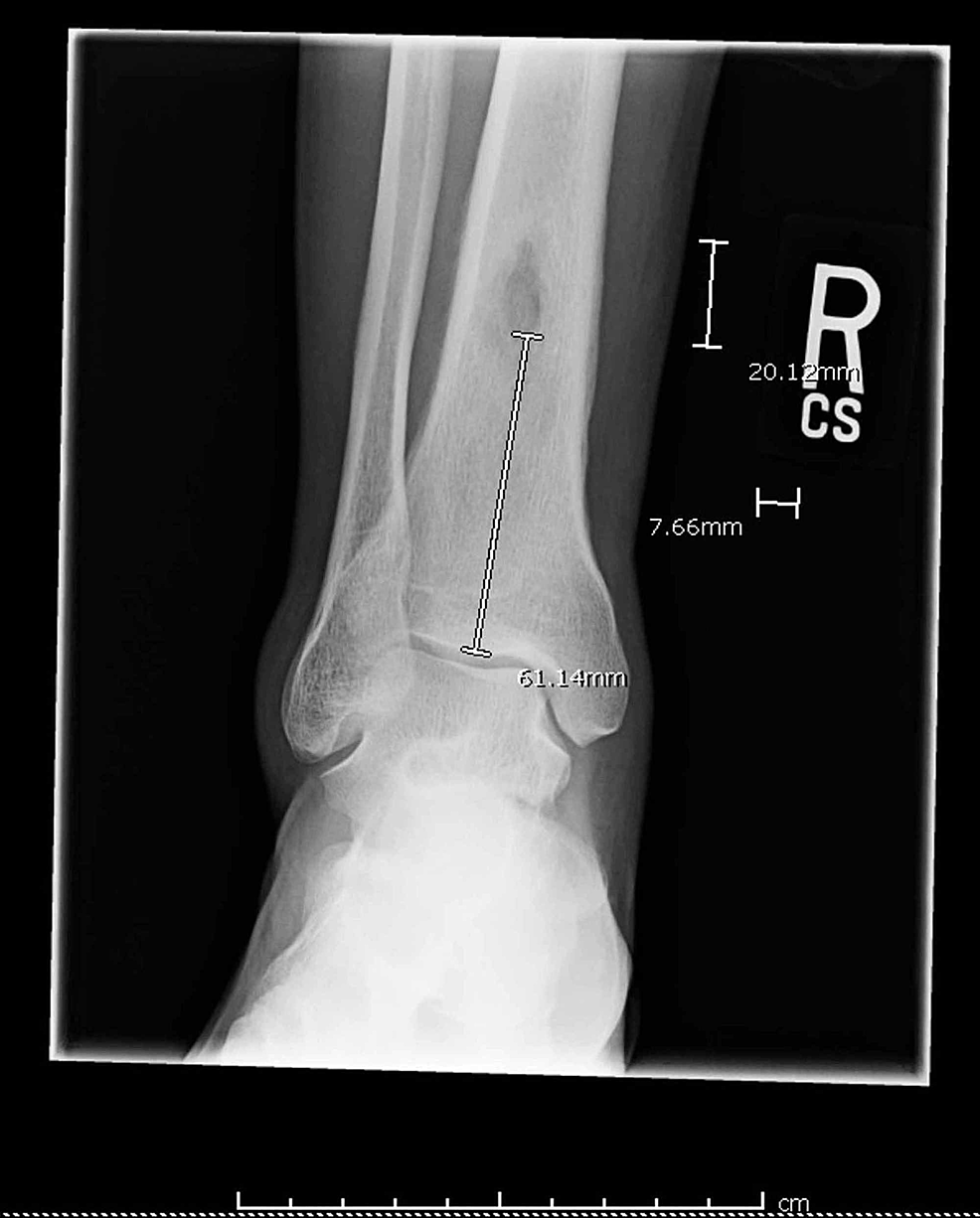 Cureus A Rare Case of Brodie s Abscess in HIV Patient Caused by