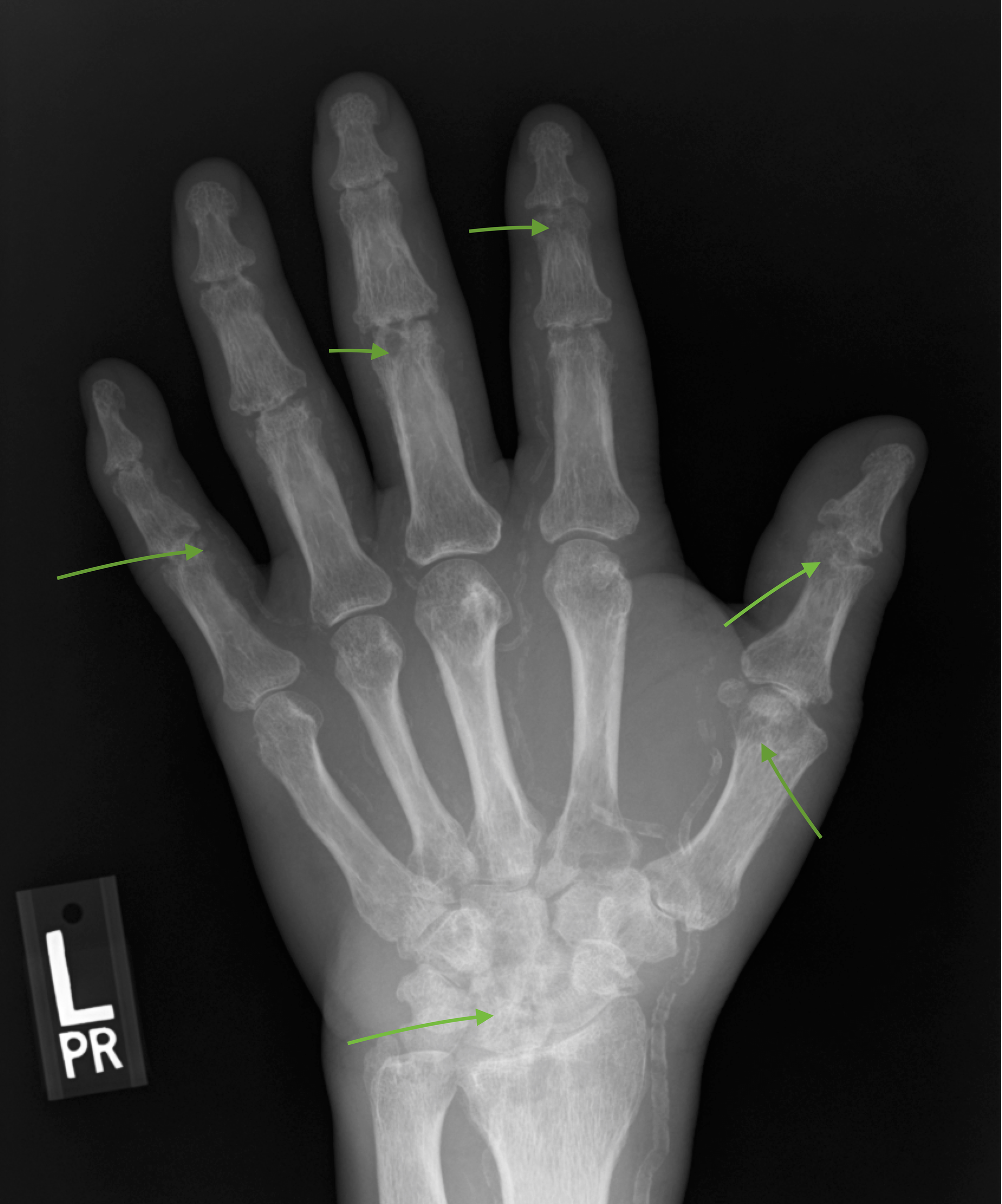 Cureus | A Case Report on Adult-Onset Still’s Disease Successfully ...