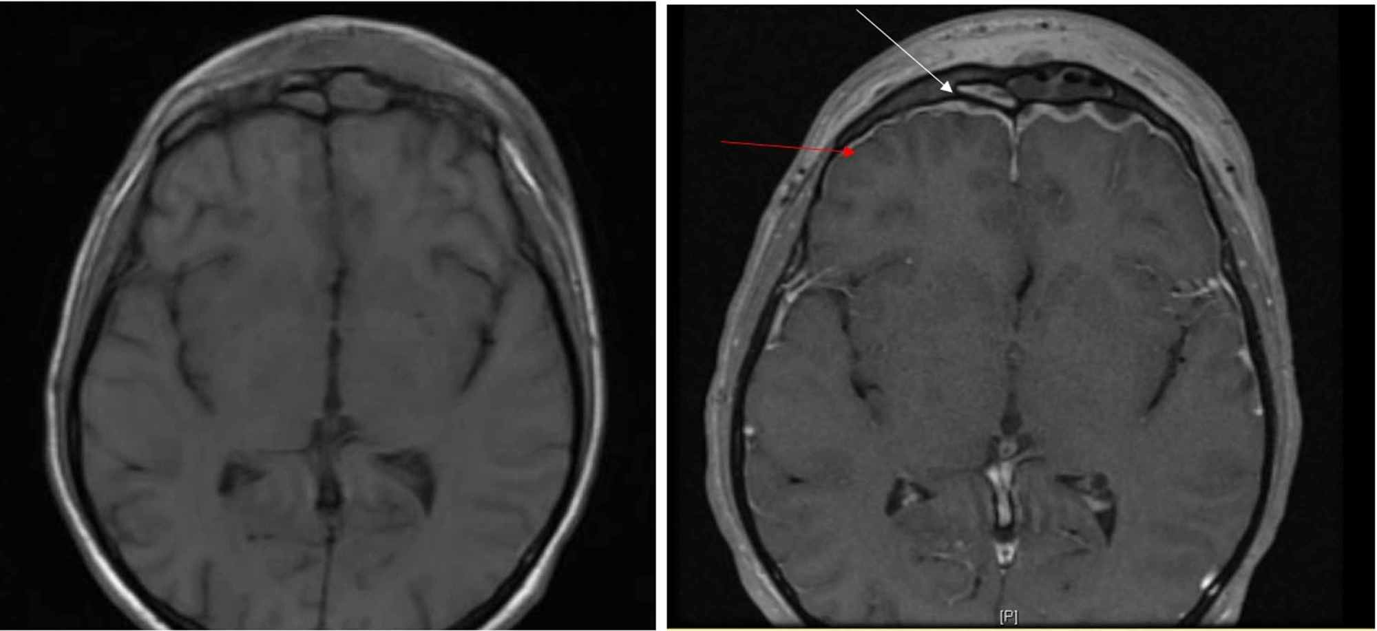 Cureus Pott's Puffy Tumor Intracranial Extension Not Requiring