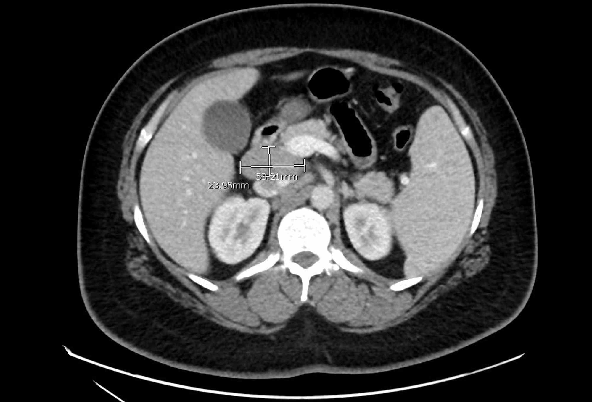 mesothelioma with liver metastases