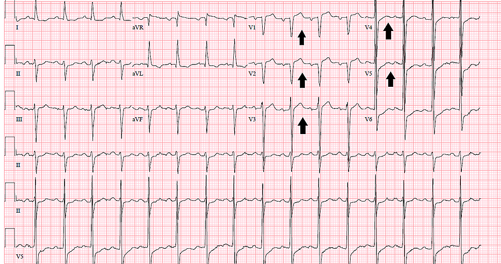 Cureus | Transient Cardiac Dysfunction in Cerebrovascular Accidents