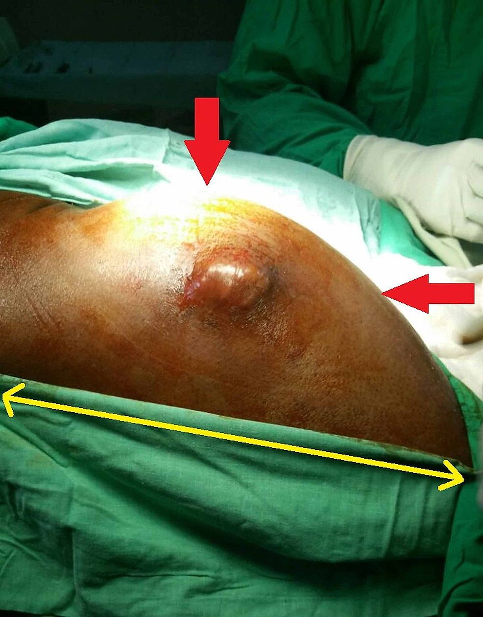 Soft Tissue Masses — What Is This Lump?: Surgical Associates of North  Texas: Advanced Laparoscopic Surgeons