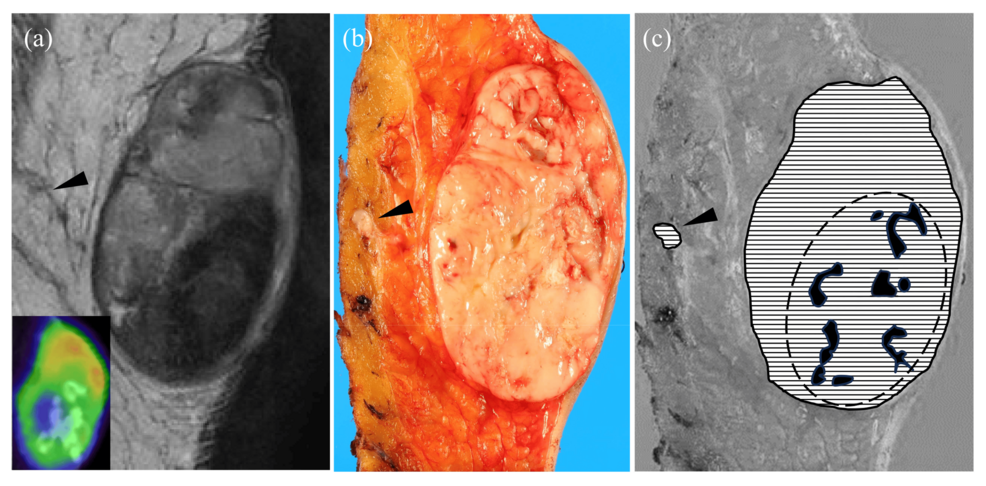 Malignant Ossifying Fibromyxoid Tumor With Lung Metastasis: A Case