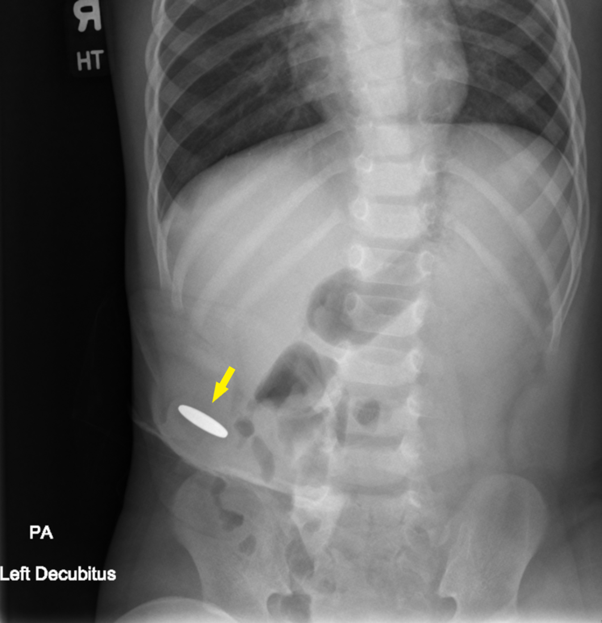 Cureus Not Just for Urine A Versatile Tool for Foreign Body Removal