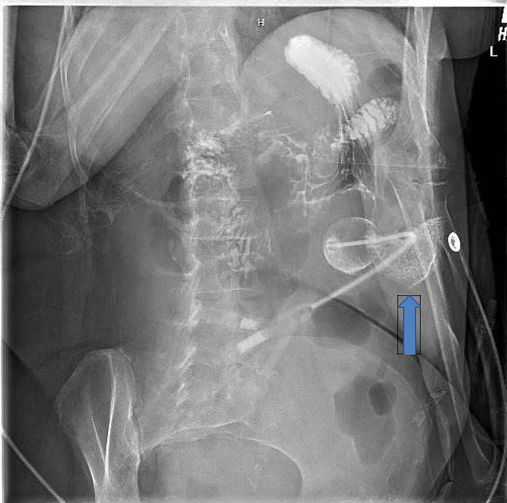 Cureus An Early Presentation of Buried Bumper Syndrome