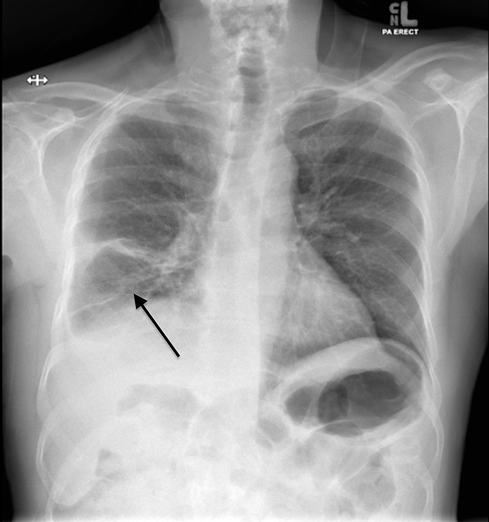 Cureus | A Rare Case of a Massive Food Bolus Mimicking Lung Cancer