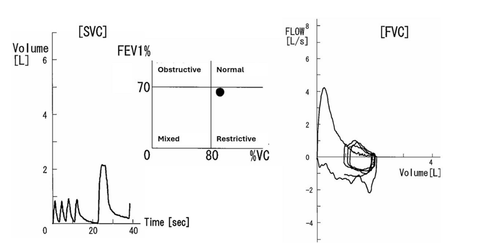Preoperative-spirometry-of-the-present-case.