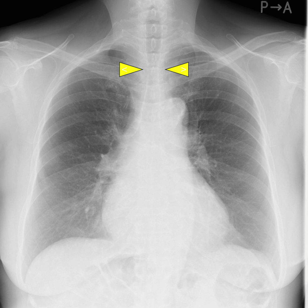 The-preoperative-chest-X-ray-image-of-the-present-case.
