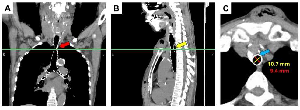 Postoperative-computed-tomography-multi-planar-reconstruction-image-of-the-present-case.