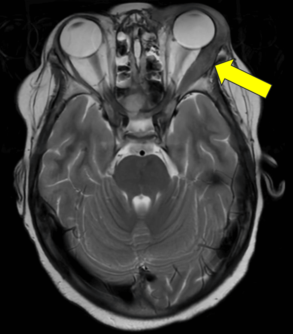 Resonancia magnética ponderada en T2 axial que muestra una lesión que afecta el músculo recto lateral y la órbita del ojo izquierdo (flecha amarilla).