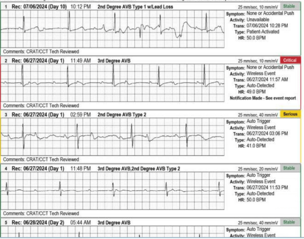 Holter-findings-indicating-heart-block-in-the-patient.