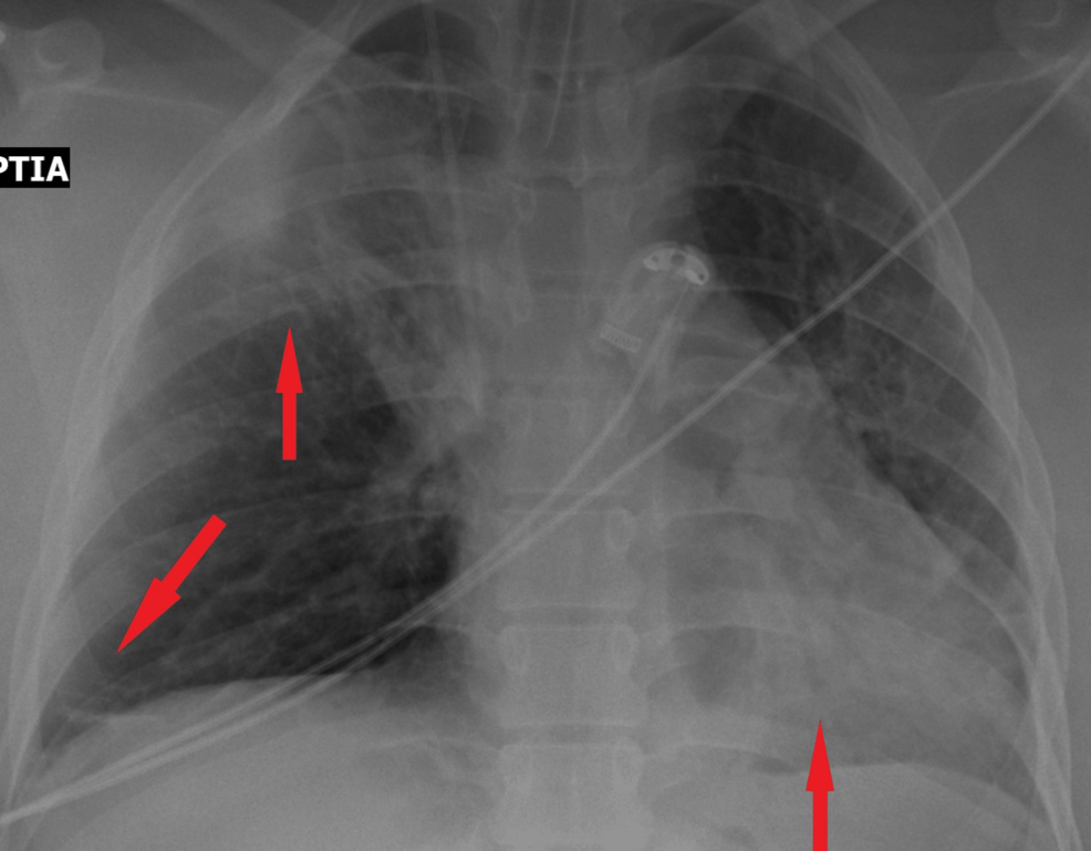 X-ray-of-chest-with-atelectasis-of-the-upper-right-lobe-and-both-lower-lobes.