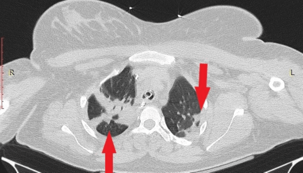 Computed-tomography-(CT)-of-chest-in-the-axial-plane-with-intravenous-contrast-showing-atelectasis-of-both-lower-lobes.