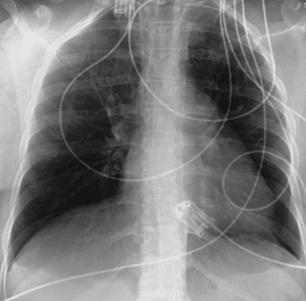 X-ray-of-chest-on-the-day-of-discharge-from-the-ICU-(Intensive-Care-Unit)-which-was-normal.