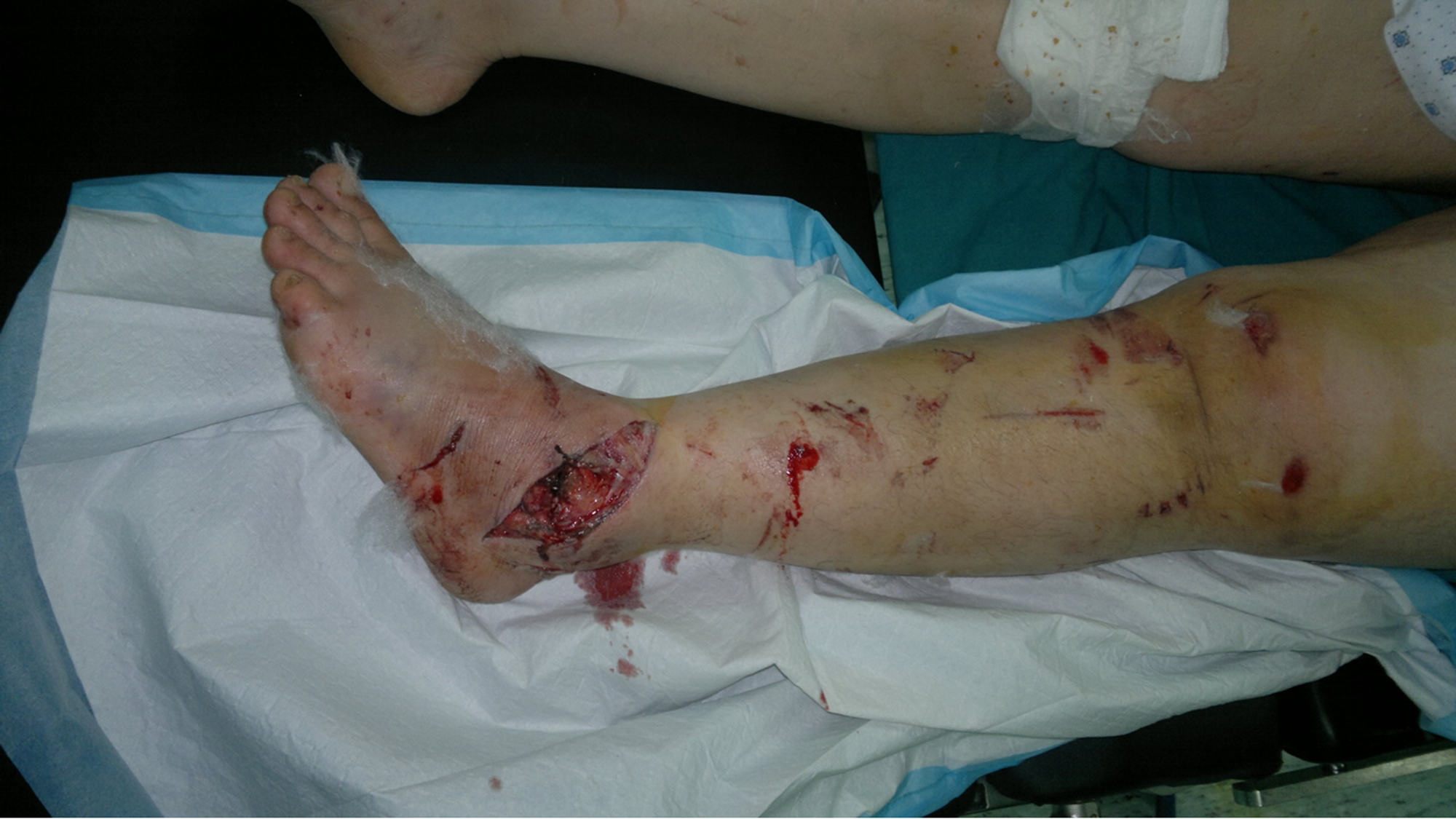 Cureus Complete Extrusion of Talar Body Associated With Ipsilateral