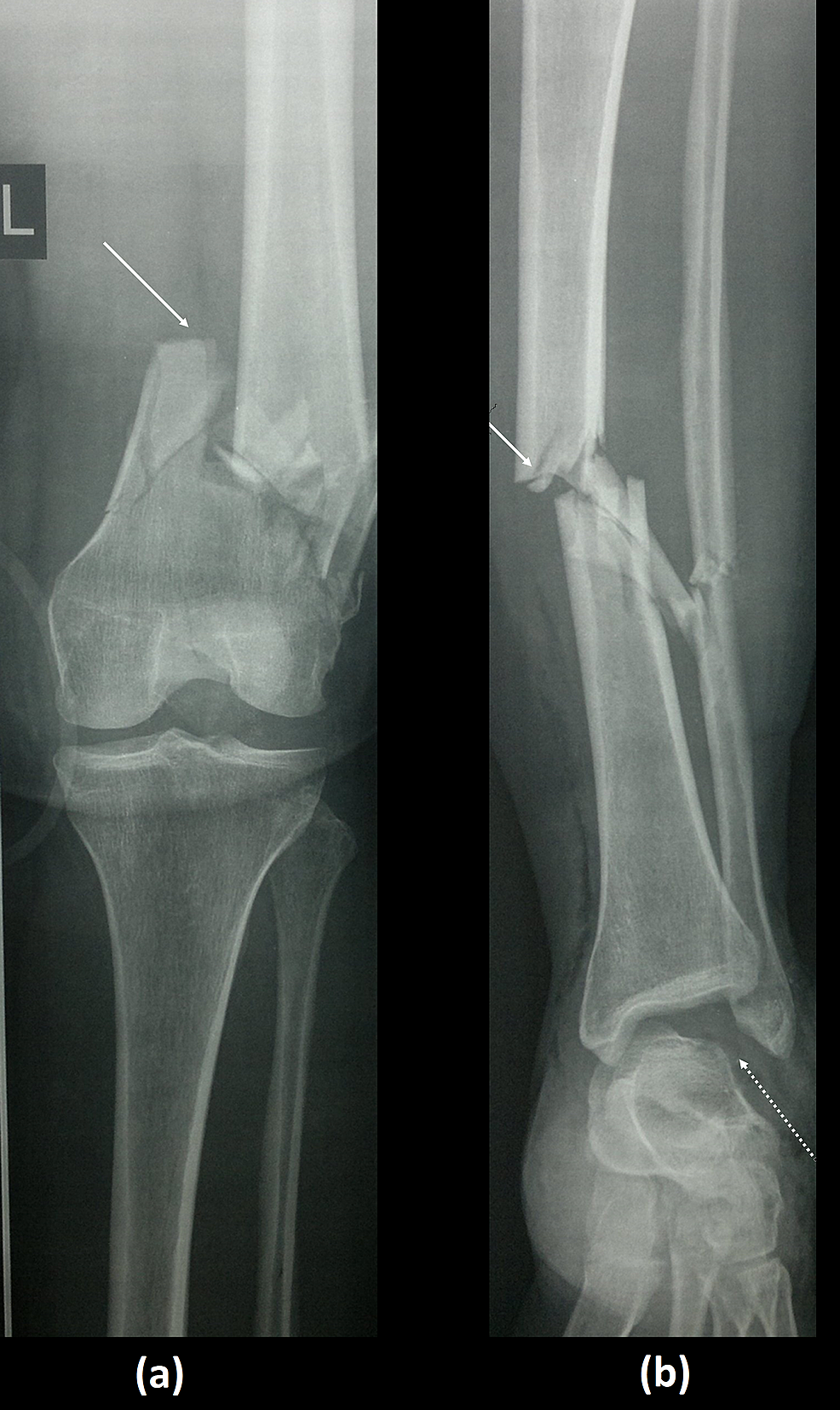 Cureus Complete Extrusion of Talar Body Associated With Ipsilateral