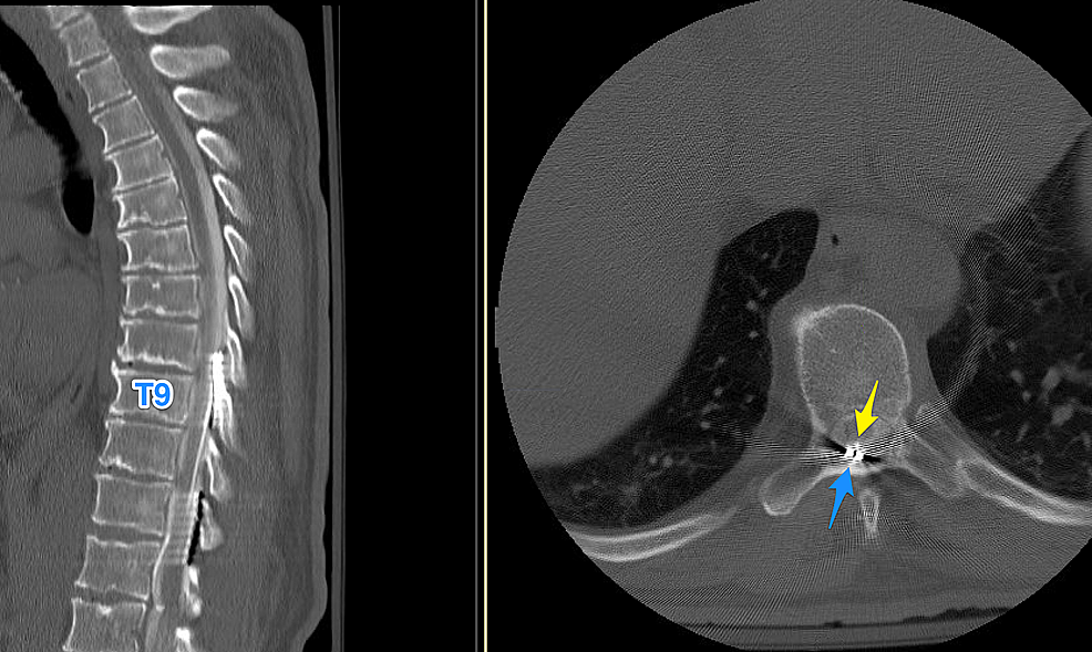 cureus-toxic-myelitis-and-arachnoiditis-after-intrathecal-delivery-of