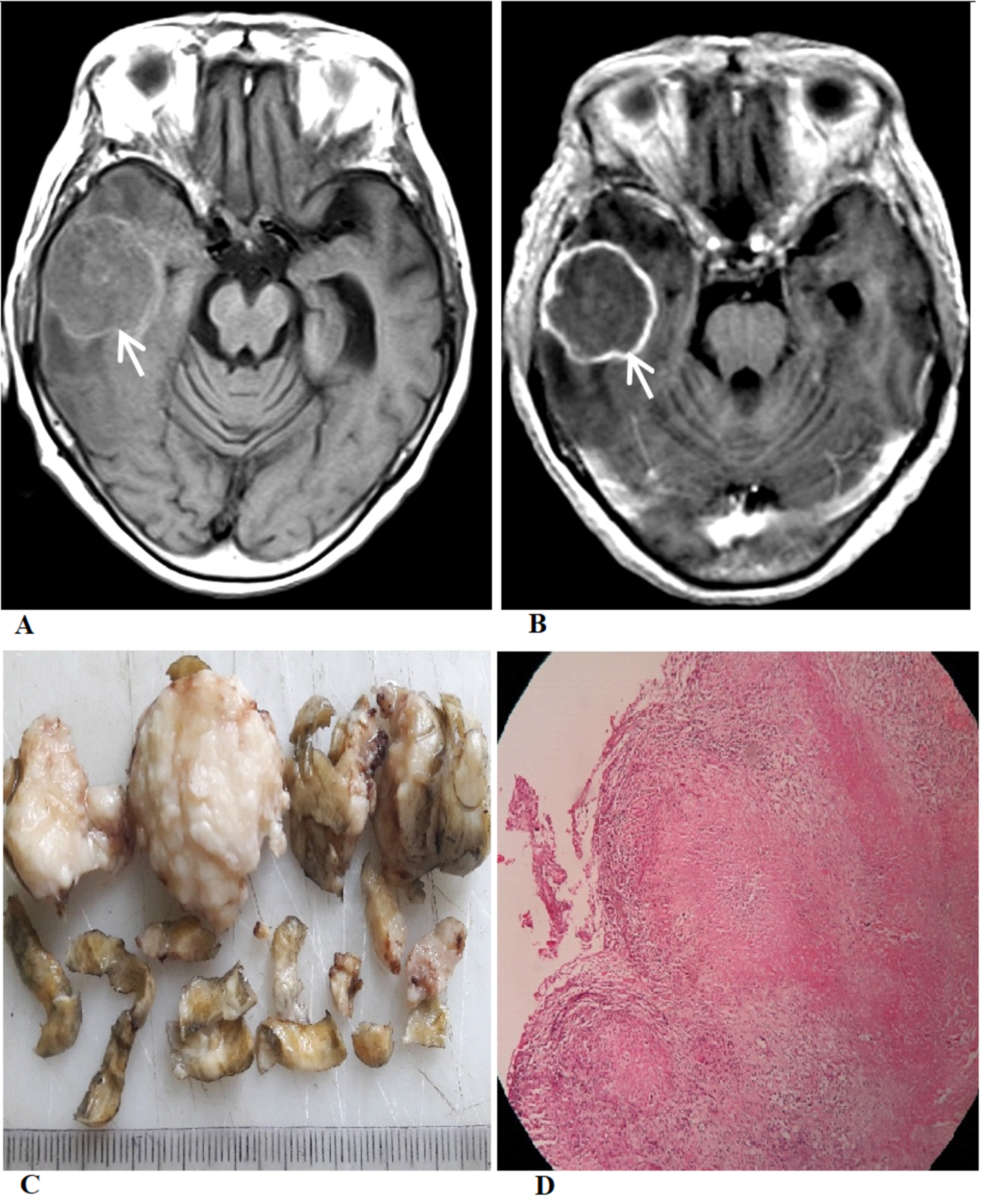 Cureus Giant Cerebral Tuberculoma Masquerading As Malignant Brain Tumor A Report Of Two Cases