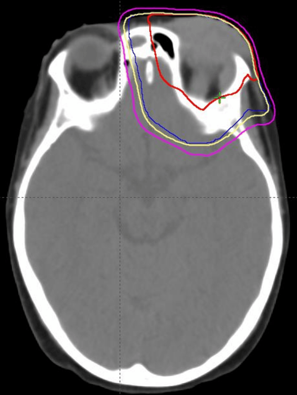 Imagen de planificación del tratamiento de radiación que muestra el volumen bruto del tumor (rojo), el volumen objetivo de planificación (azul), la línea de isodosis del 95 % (amarillo) y la línea de isodosis del 80 % (magenta).