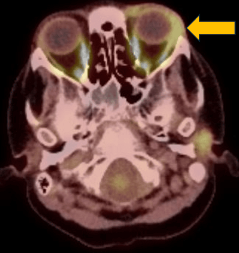 Tomografía por emisión de positrones previa al tratamiento que muestra una lesión hipermetabólica en la órbita izquierda (flecha amarilla), compatible con sarcoma mieloide orbitario.