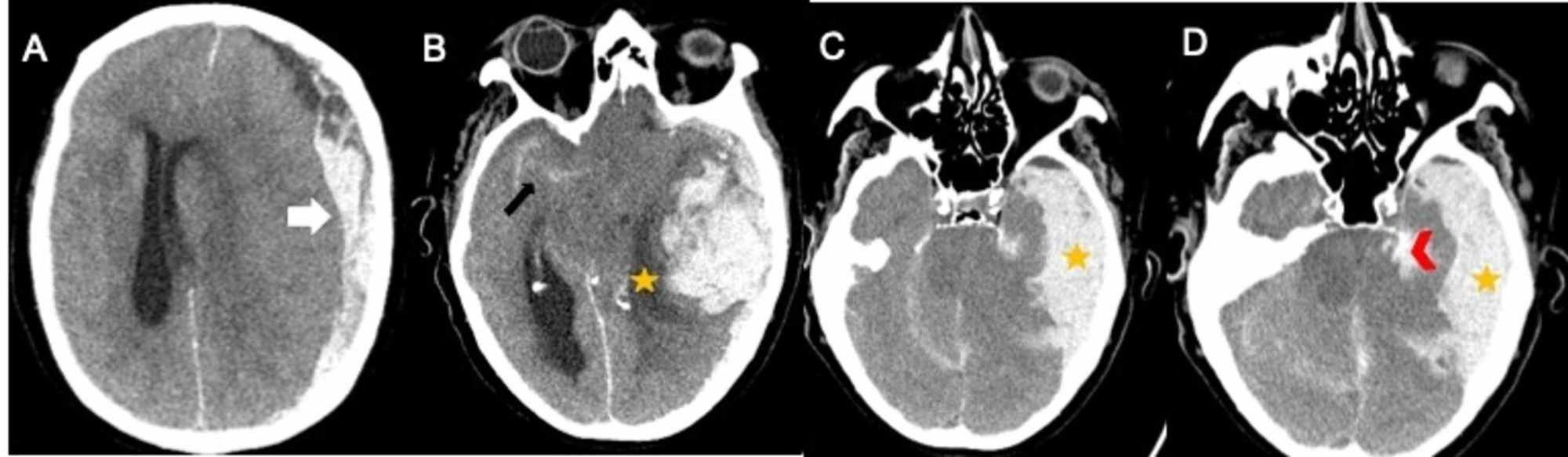 Cureus Intracranial Hemorrhage in a Patient With COVID19 Possible