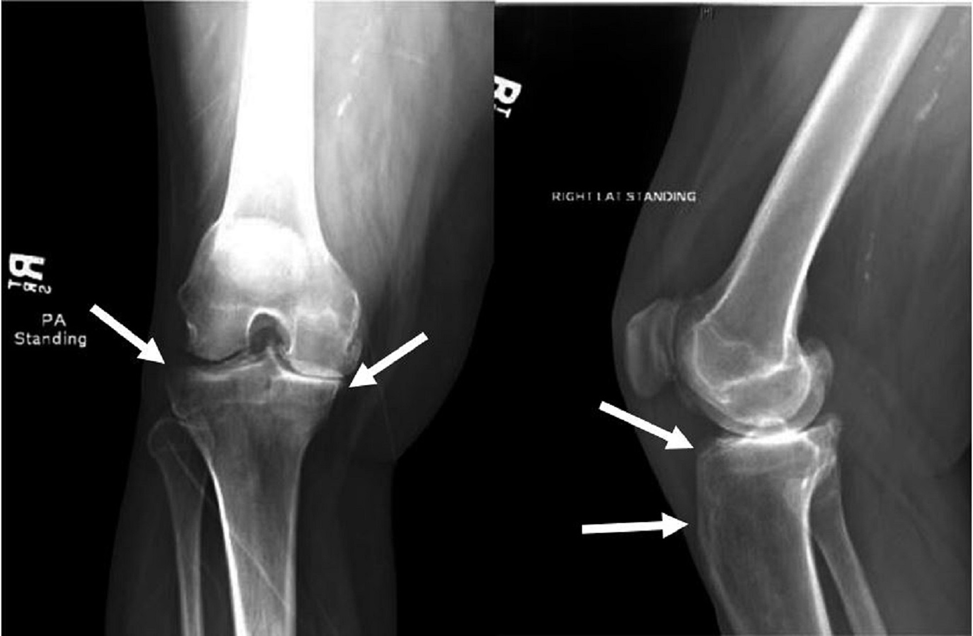 Cureus Chronic Salmonella Osteomyelitis in a Diabetic Patient