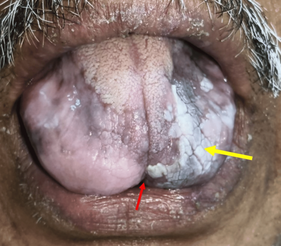 smokeless tobacco can cause all of the following except Know Facts! Flex Seal Spray: Worry Less