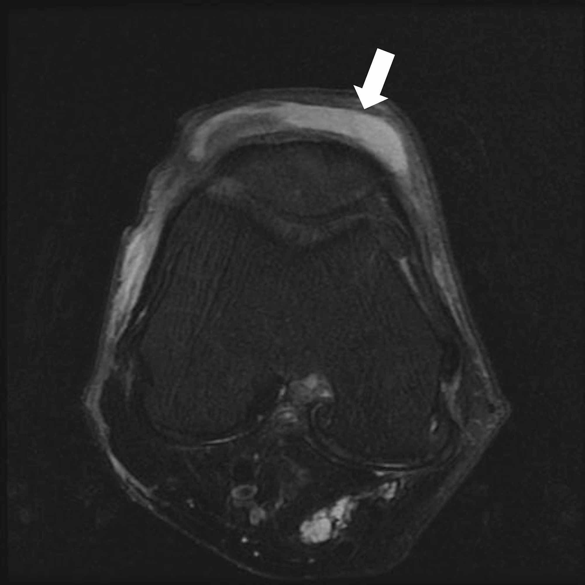 Cureus Housemaid’s Knee (Prepatellar Septic Bursitis)