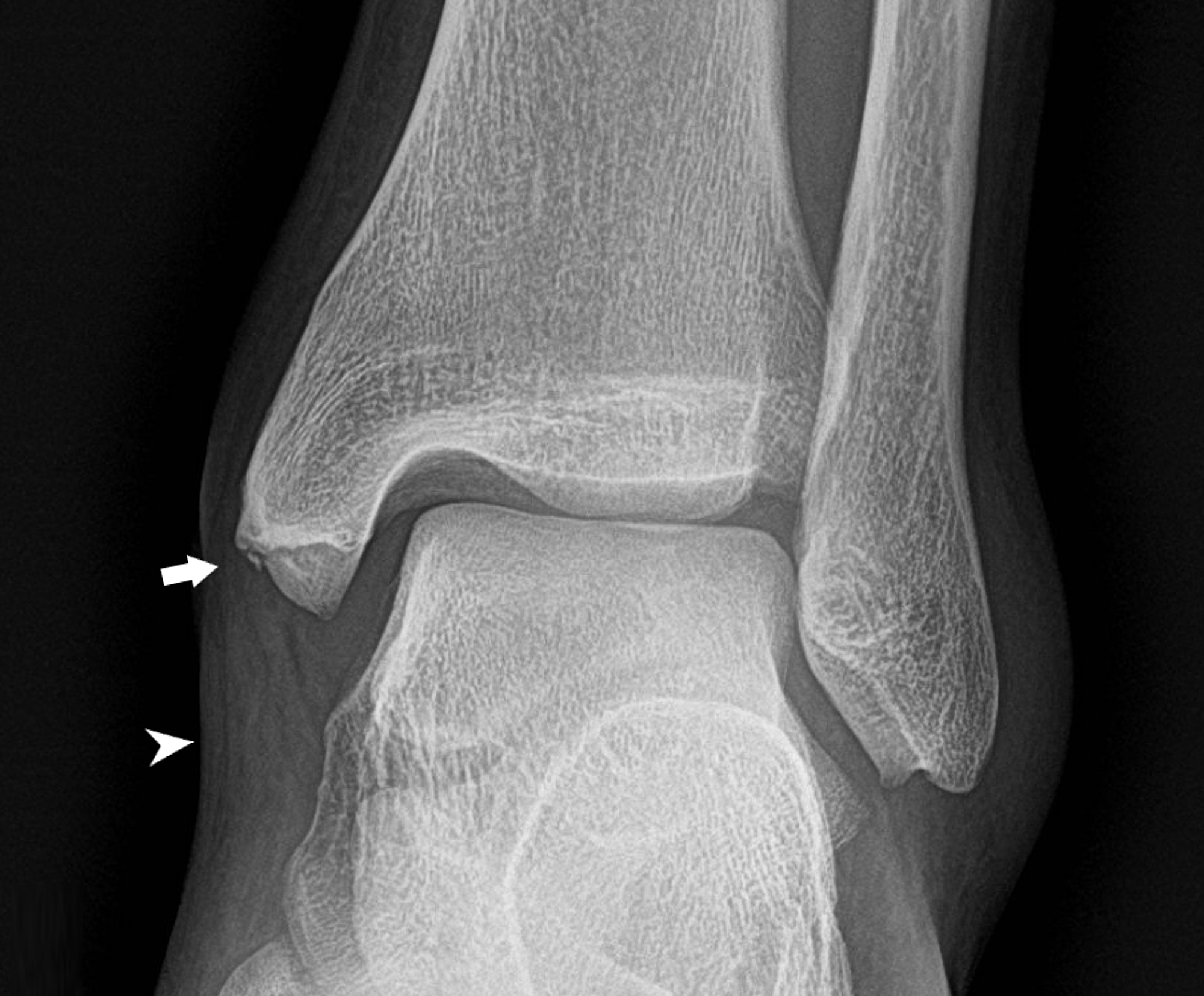 lateral malleolus fracture picture