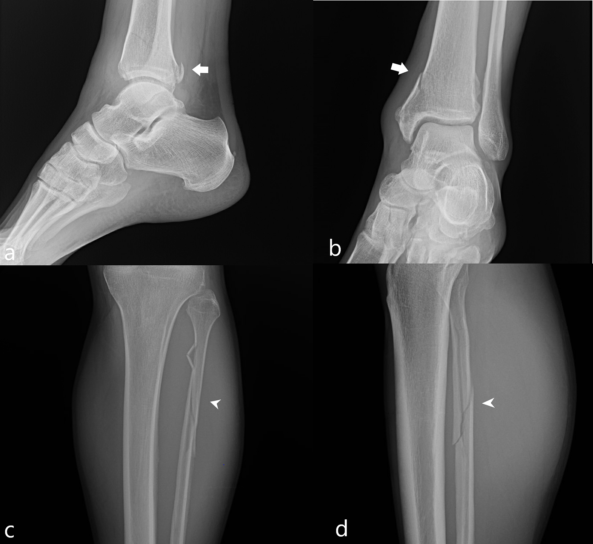 lateral malleolus fracture icd10