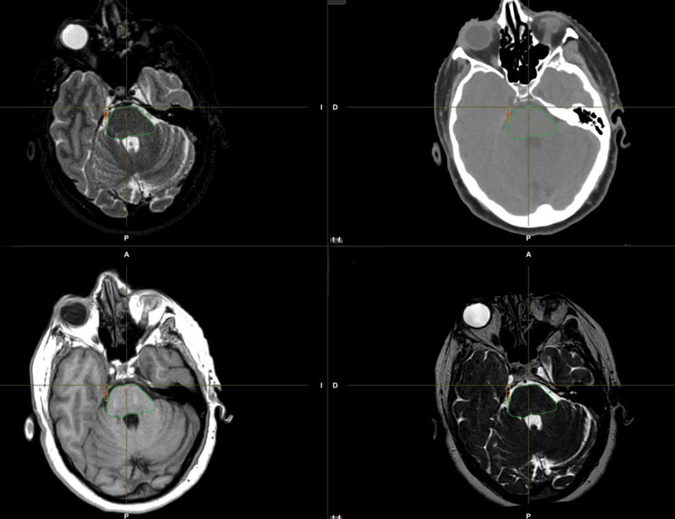 Target-volume-delineation-in-the-right-trigeminal-nerve.