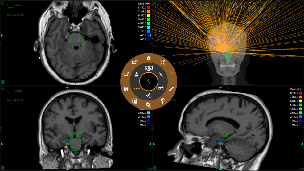 Dose-distribution-and-beam-evaluation-in-a-patient-with-right-trigeminal-neuralgia.