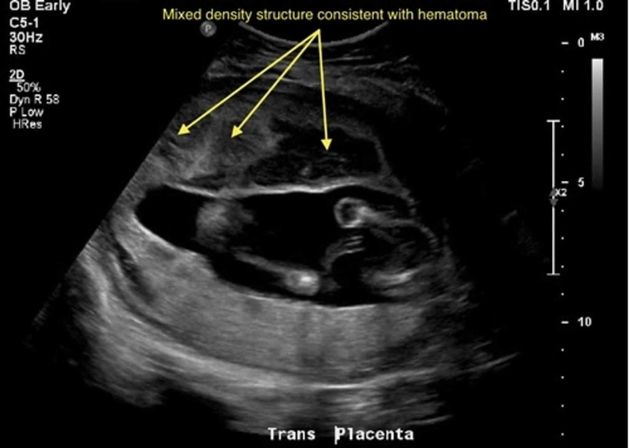 Placental Hemorrhage Ultrasound