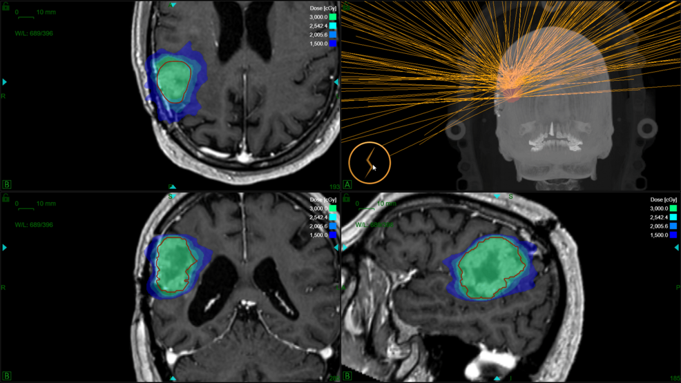 Dose-distribution-of-a-gyroscopic-radiosurgery-reirradiation-in-five-fractions-with-a-total-dose-of-30-Gy-in-a-patient-with-recurrent-glioblastoma. Dose-distribution-of-a-gyroscopic-radiosurgery-reirradiation-in-five-fractions-with-a-total-dose-of-30-Gy-in-a-patient-with-recurrent-glioblastoma.