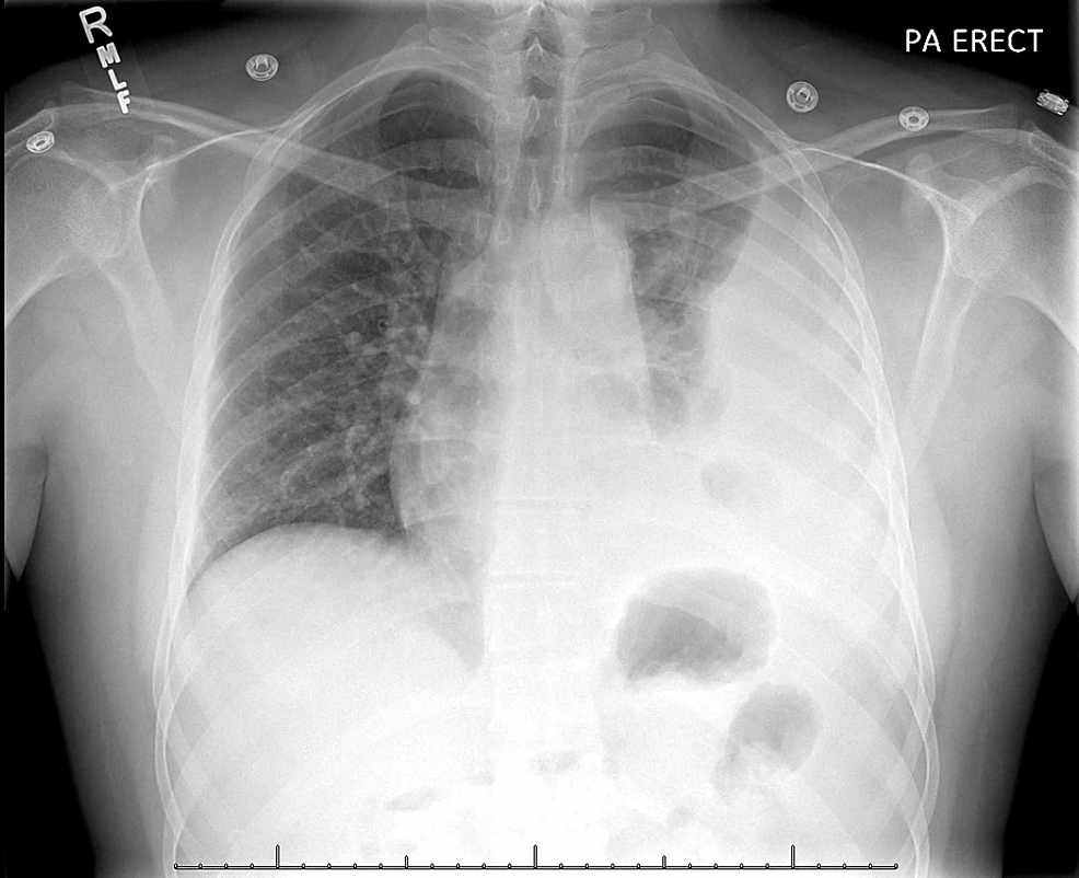 Initial-chest-x-ray-of-the-patient-showing-left-sided-pleural-effusion-with-atelectasis.