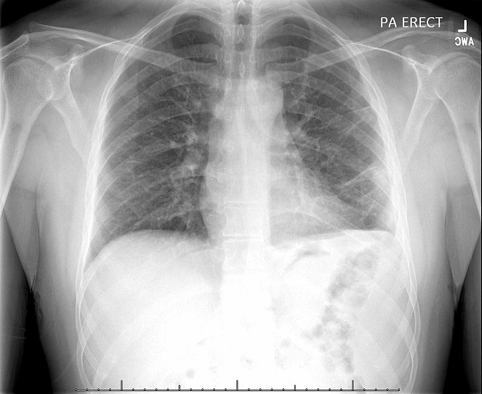 Follow-up-chest-x-ray,-months-into-anti-tuberculous-therapy-showing-significant-improvement.