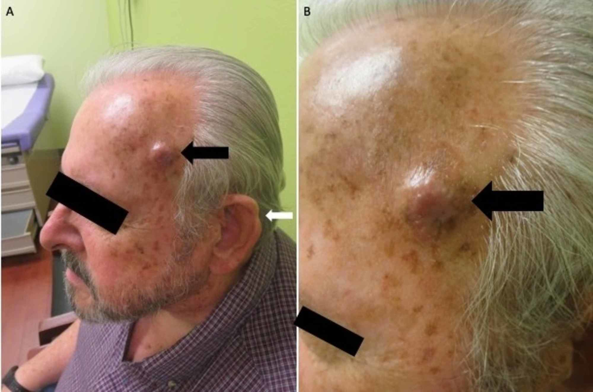Cureus Metastatic Squamous Cell Carcinoma A Cautionary Tale