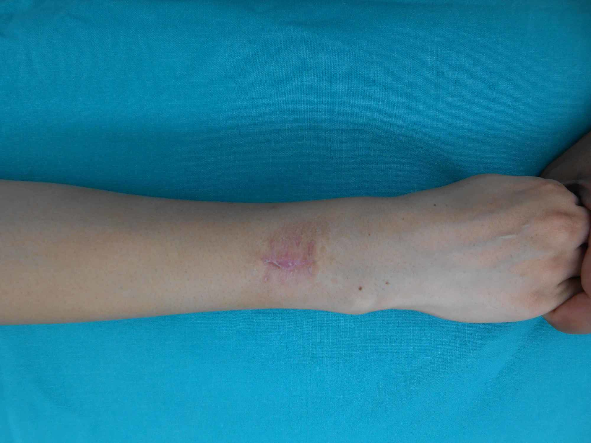 Cureus Lateral Arm Flap Its Usage as Pedicle and Free Flap